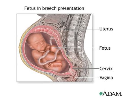 Anatomical diagram showing fetus in breech position with labeled uterus, cervix, vagina