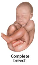 Complete breech presentation - both hips and knees flexed
