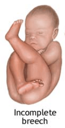 Incomplete breech presentation - one or both feet presenting