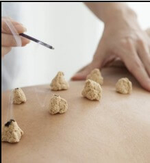 Traditional Chinese medicine moxibustion technique illustration