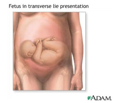 Fetus in transverse lie presentation