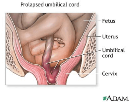 Umbilical cord prolapse diagram showing fetus, uterus, umbilical cord, and cervix