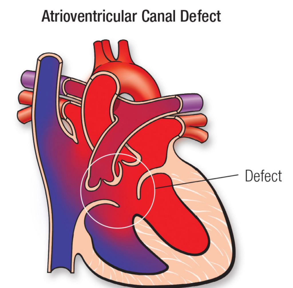 Atrioventricular Canal Defect