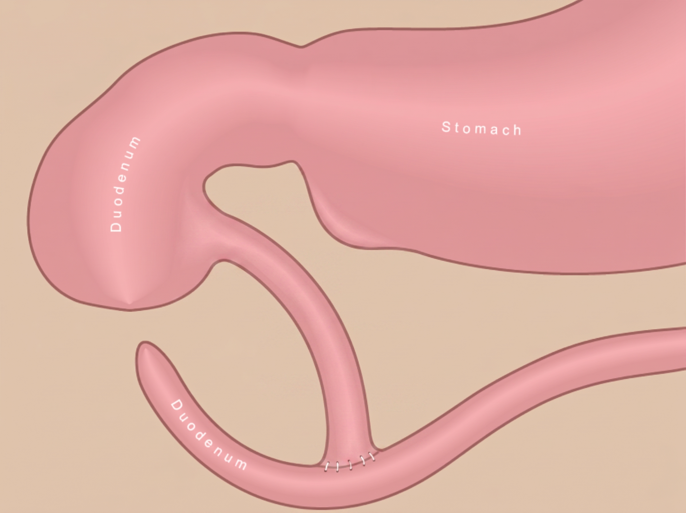 Duodenal atresia after surgical repair showing reconnected bowel