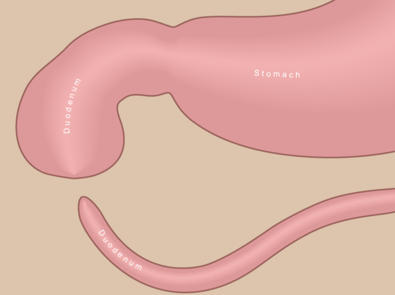 Duodenal atresia before surgery showing blockage after the stomach