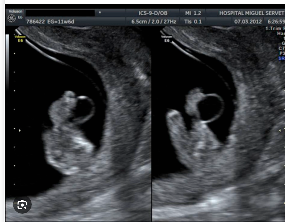 Ultrasound image showing a fluid-filled cyst along the umbilical cord